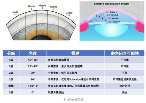 房角|前房角检查的意义